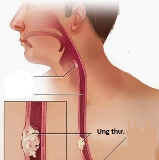 Bệnh ung thư thực quản là gì?