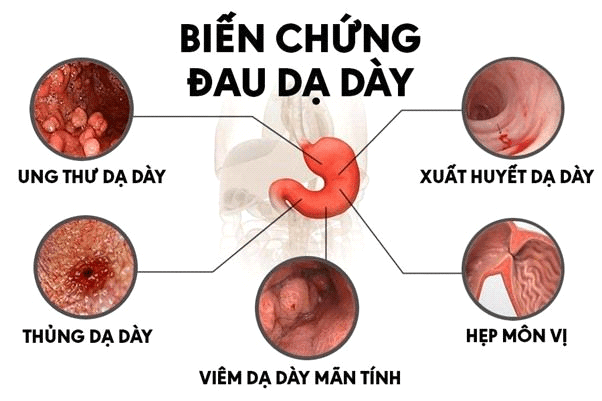 Viên dạ dày plus - Bước cải tiến mới giúp hỗ trợ giảm các triệu chứng dạ dày tá tràng từ sâu bên trong