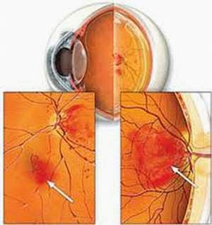 Bài thuốc hỗ trợ điều trị đái tháo đường