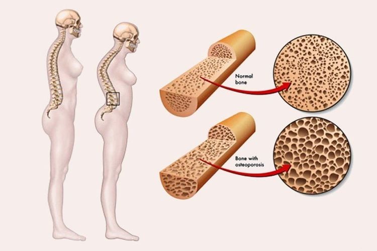 Các nhóm thuốc tân dược điều trị tiểu đường type 2