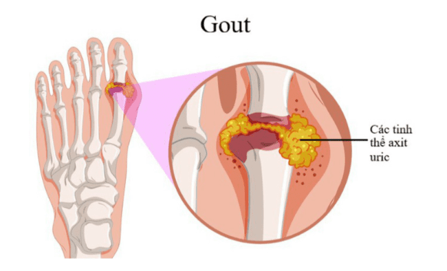 Biến chứng nguy hiểm của bệnh Gout