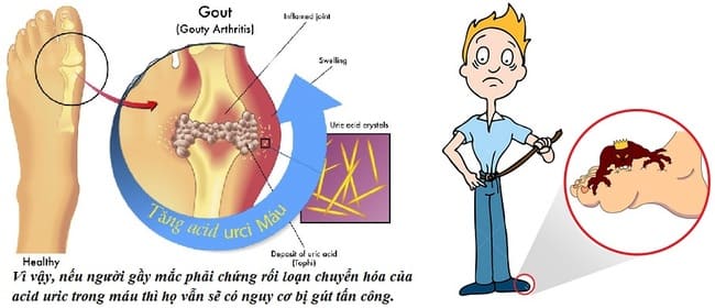 Tăng Acid uric trong máu có phải bị Gout?