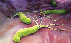 Trẻ nhiễm khuẩn HP dạ dày khi nào cần phải điều trị